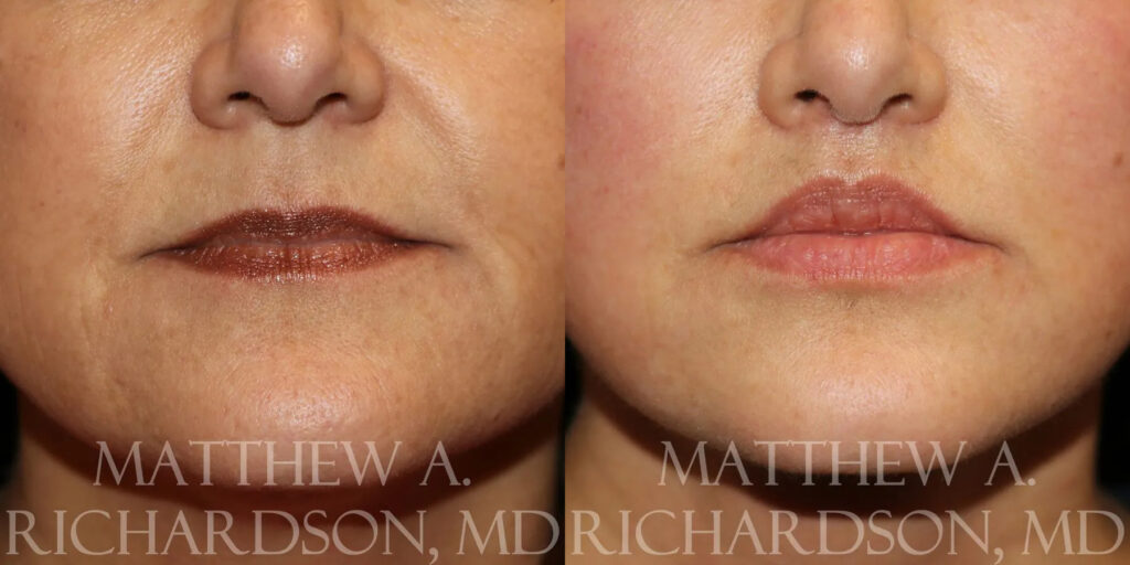 Lip Lift Before and After photo by Texas Facial Aesthetics in Frisco, TX