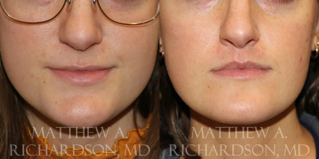 Lip Lift Before and After photo by Texas Facial Aesthetics in Frisco, TX