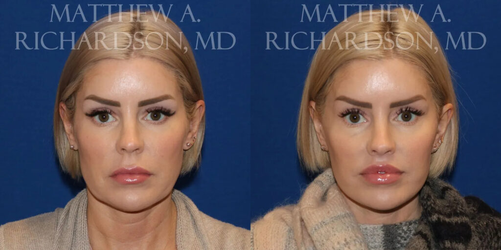 Lip Lift Before and After photo by Texas Facial Aesthetics in Frisco, TX