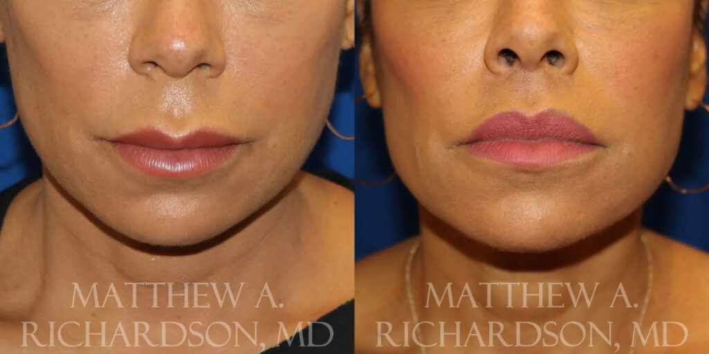 Lip Lift Before and After photo by Texas Facial Aesthetics in Frisco, TX