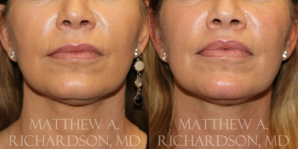 Lip Lift Before and After photo by Texas Facial Aesthetics in Frisco, TX