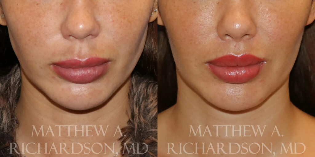 Lip Lift Before and After photo by Texas Facial Aesthetics in Frisco, TX