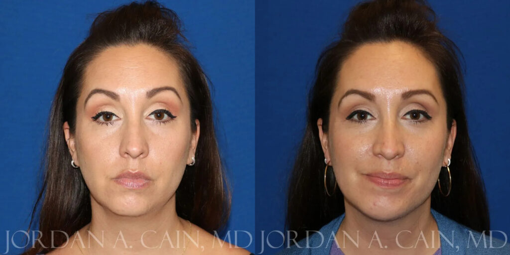 Chin Augmentation Before and After photo by Texas Facial Aesthetics in Frisco, TX