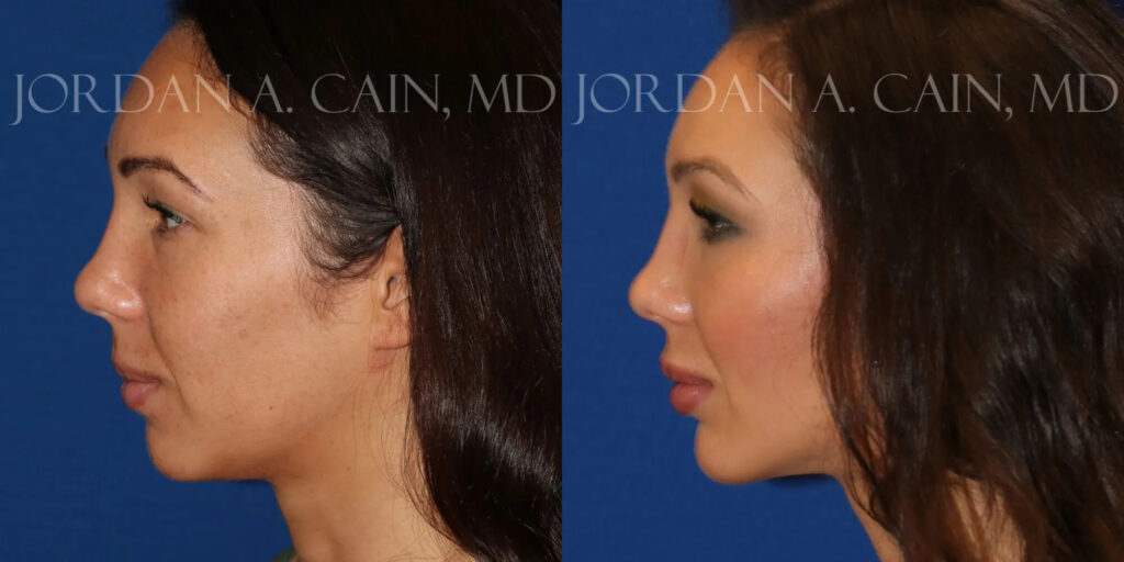 Chin Augmentation Before and After photo by Texas Facial Aesthetics in Frisco, TX