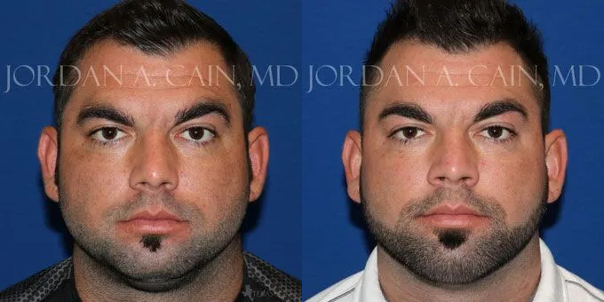 Chin Augmentation Before and After photo by Texas Facial Aesthetics in Frisco, TX