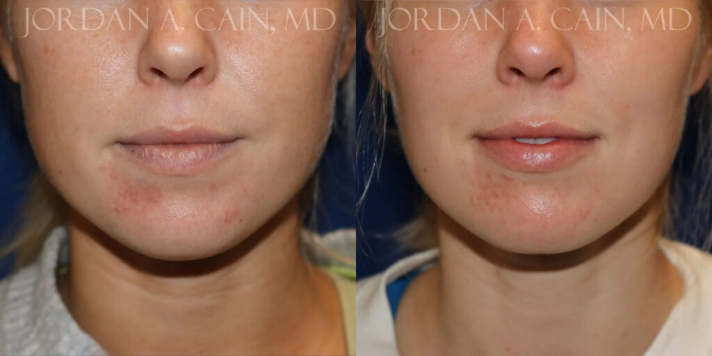 Neck Liposuction Before and After photo by Texas Facial Aesthetics in Frisco, TX