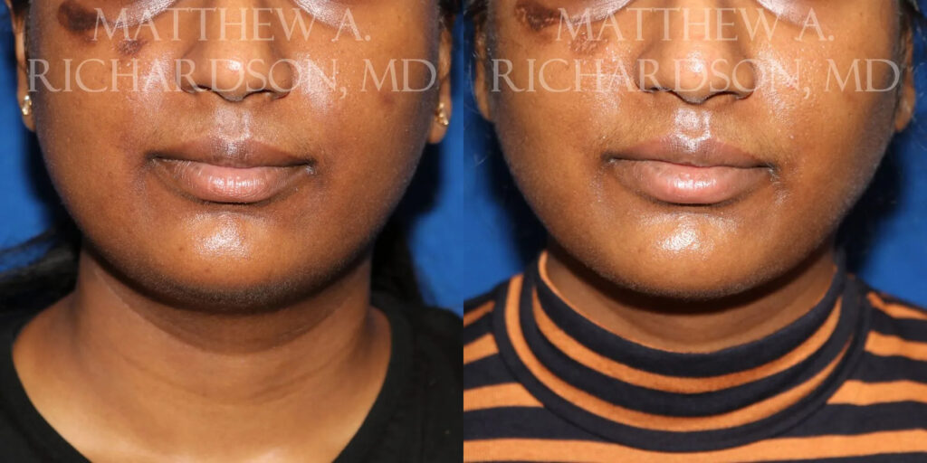 Neck Liposuction Before and After photo by Texas Facial Aesthetics in Frisco, TX