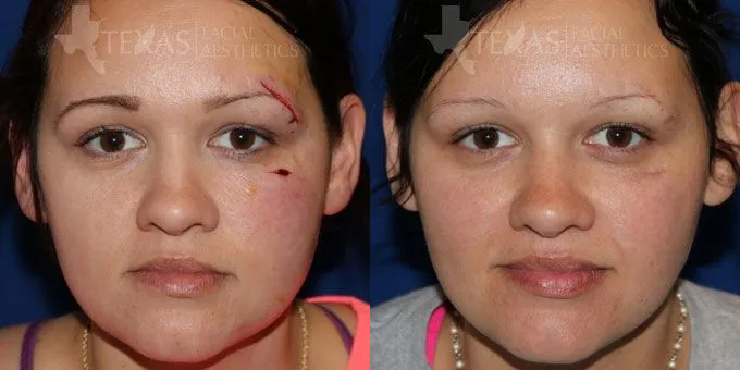 Facial Trauma Before and After photo by Texas Facial Aesthetics in Frisco, TX