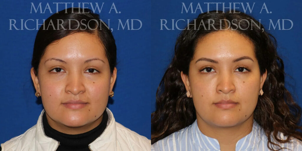 Buccal Fat Reduction Before and After photo by Texas Facial Aesthetics in Frisco, TX