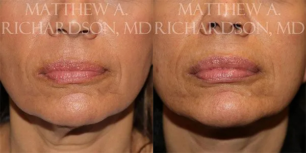 SMAS Lips Before and After photo by Texas Facial Aesthetics in Frisco, TX
