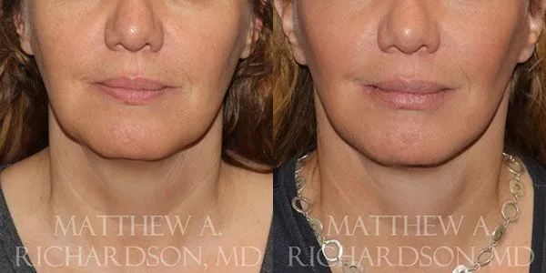 SMAS Lips Before and After photo by Texas Facial Aesthetics in Frisco, TX