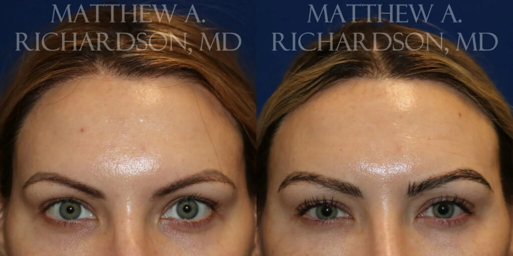 Eyebrow Transplant Before and After photo by Texas Facial Aesthetics in Frisco, TX