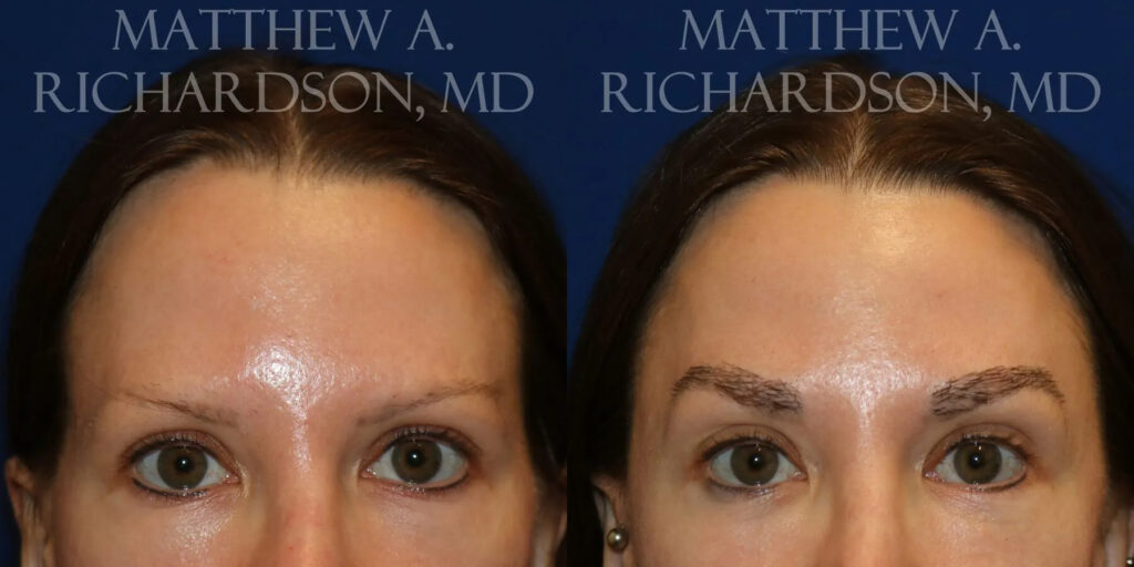 Eyebrow Transplant Before and After photo by Texas Facial Aesthetics in Frisco, TX