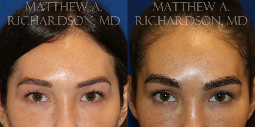 Eyebrow Transplant Before and After photo by Texas Facial Aesthetics in Frisco, TX