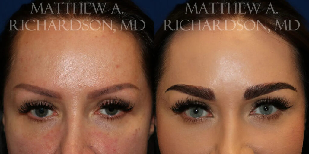 Eyebrow Transplant Before and After photo by Texas Facial Aesthetics in Frisco, TX