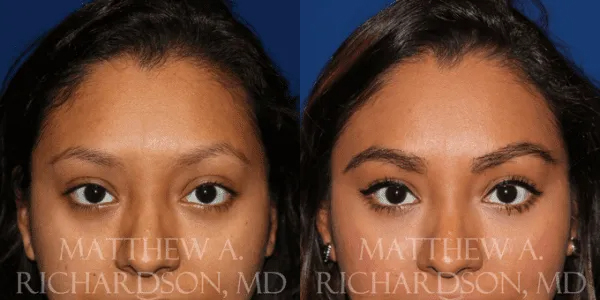 Eyebrow Transplant Before and After photo by Texas Facial Aesthetics in Frisco, TX