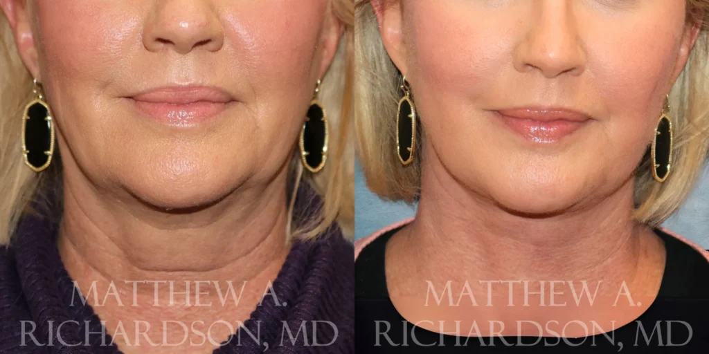 Facelift Before and After photo by Texas Facial Aesthetics in Francisco TX