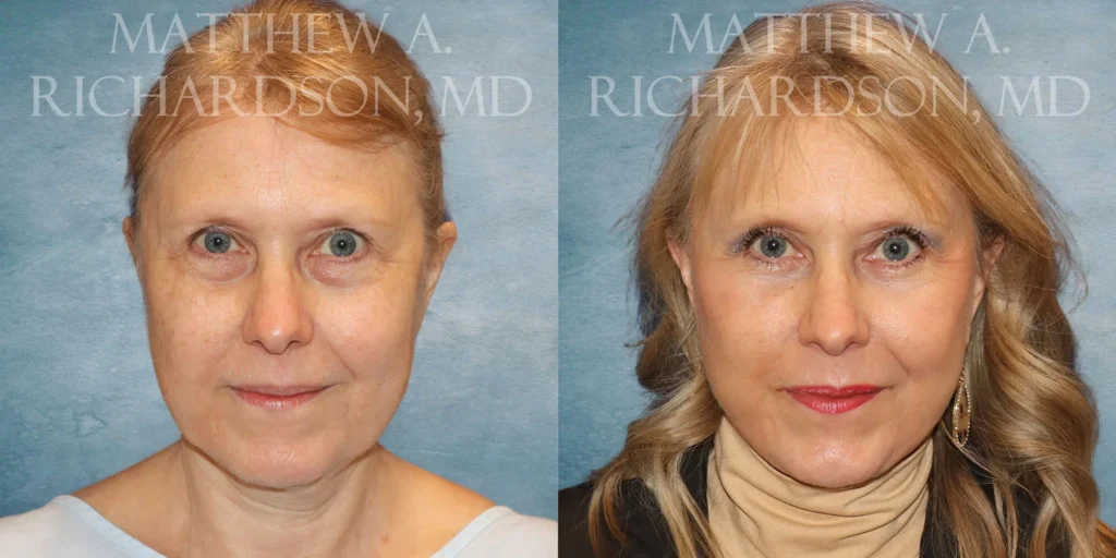 Facelift Before and After photo by Texas Facial Aesthetics in Francisco TX