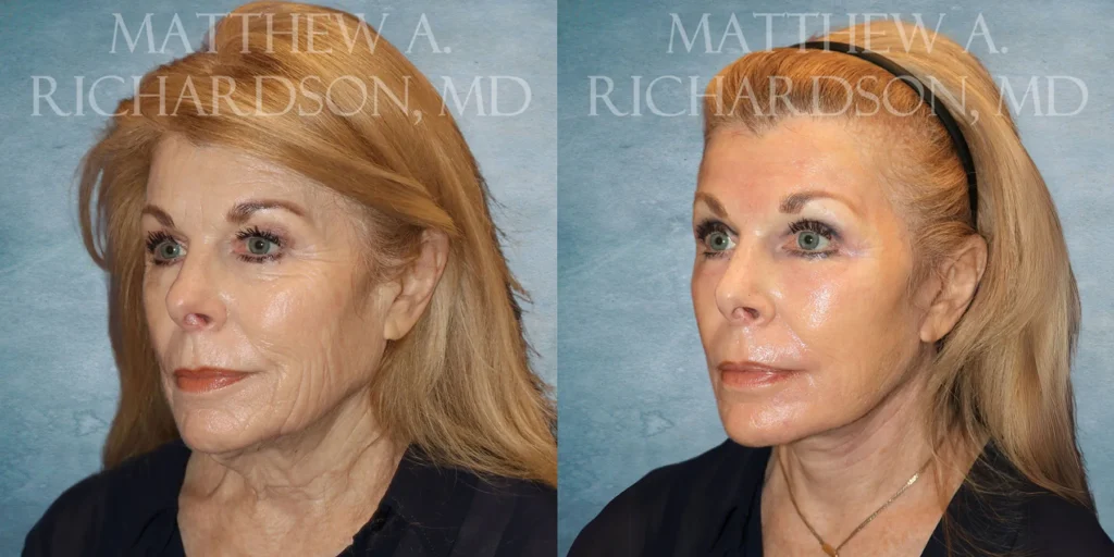 Facelift Before and After photo by Texas Facial Aesthetics in Francisco TX