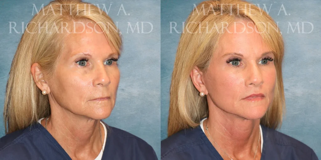 Facelift Before and After photo by Texas Facial Aesthetics in Francisco TX