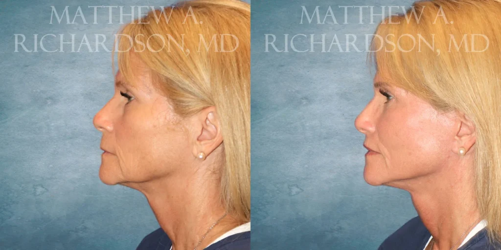 Facelift Before and After photo by Texas Facial Aesthetics in Francisco TX