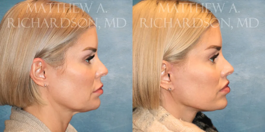 Facelift Before and After photo by Texas Facial Aesthetics in Francisco TX