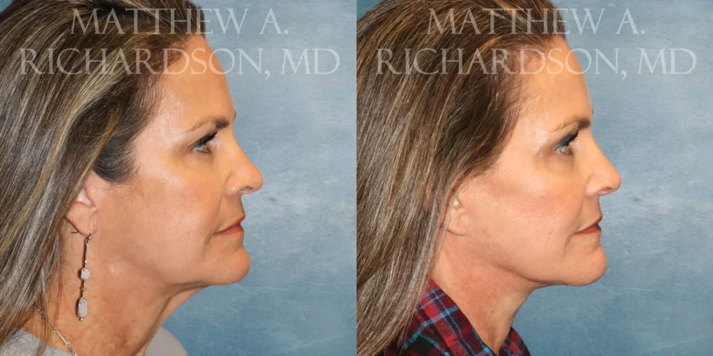 Facelift Before and After photo by Texas Facial Aesthetics in Francisco TX