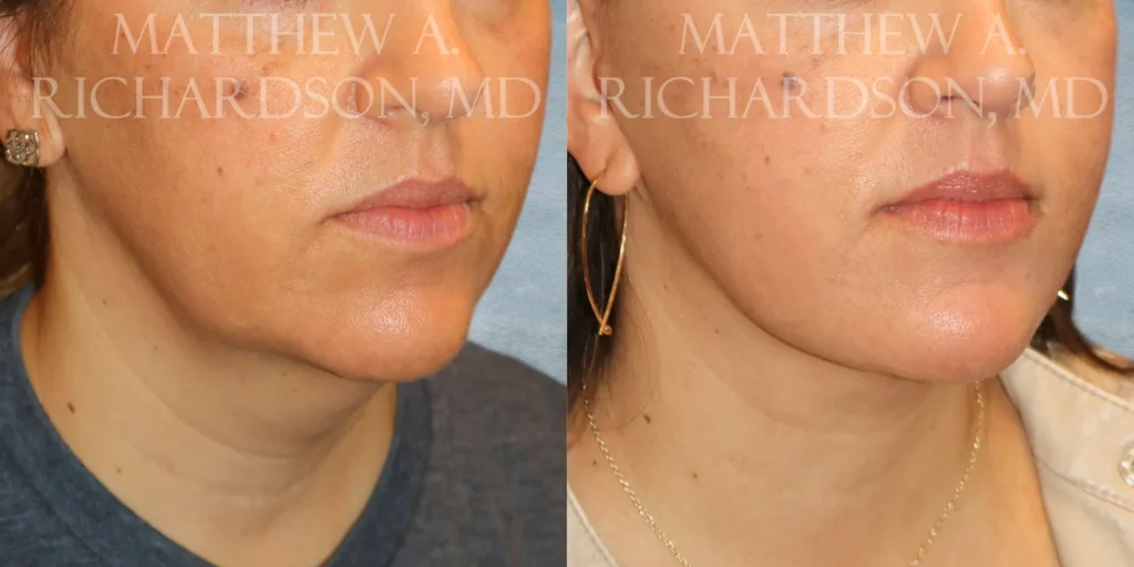 Facelift Before and After photo by Texas Facial Aesthetics in Francisco TX
