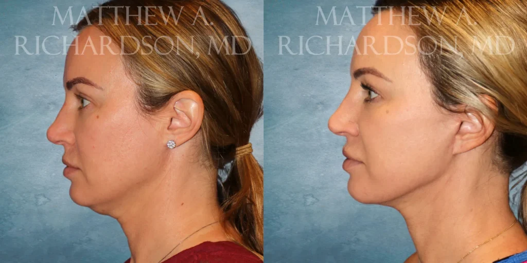Facelift Before and After photo by Texas Facial Aesthetics in Francisco TX