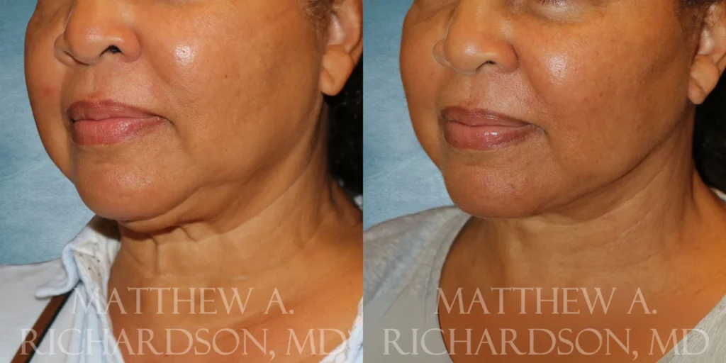 Facelift Before and After photo by Texas Facial Aesthetics in Francisco TX
