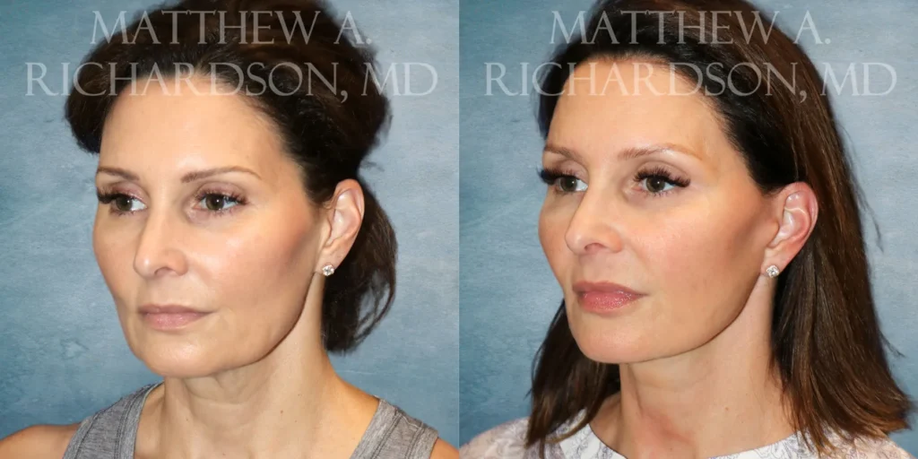 Facelift Before and After photo by Texas Facial Aesthetics in Francisco TX