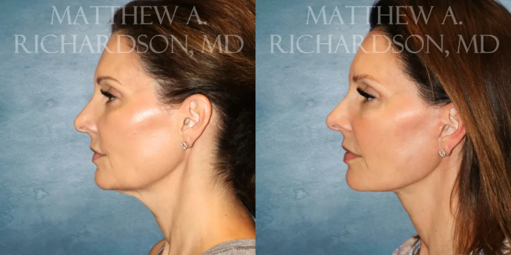 Facelift Before and After photo by Texas Facial Aesthetics in Francisco TX
