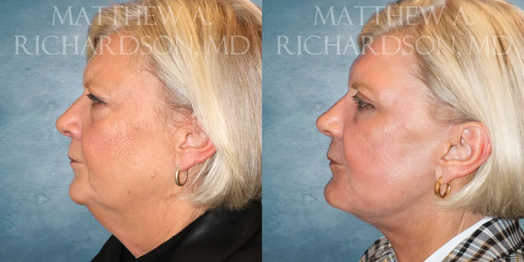 Facelift Before and After photo by Texas Facial Aesthetics in Francisco TX