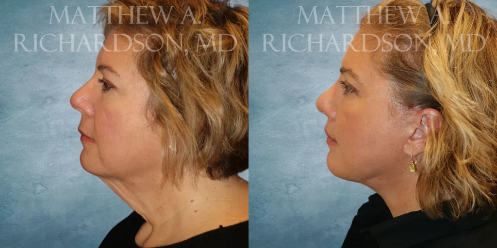 Facelift Before and After photo by Texas Facial Aesthetics in Francisco TX