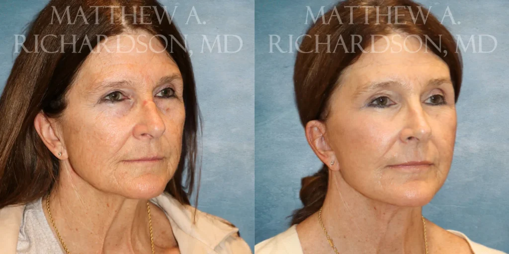 Facelift Before and After photo by Texas Facial Aesthetics in Francisco TX