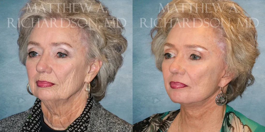 Facelift Before and After photo by Texas Facial Aesthetics in Francisco TX