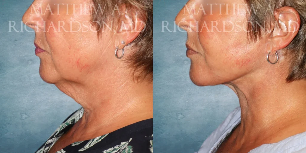 Facelift Before and After photo by Texas Facial Aesthetics in Francisco TX