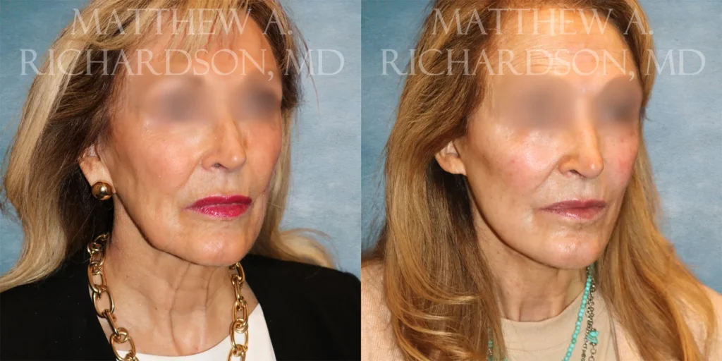Facelift Before and After photo by Texas Facial Aesthetics in Francisco TX