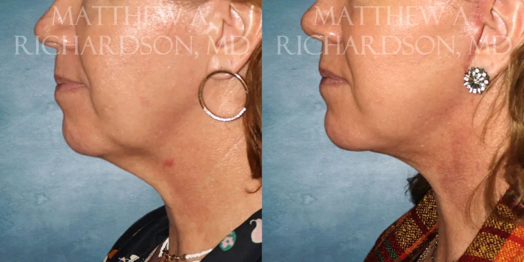 Facelift Before and After photo by Texas Facial Aesthetics in Francisco TX