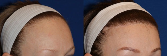 Hairline Lowering Forehead Reduction Before and After photo by Texas Facial Aesthetics in Frisco TX Hairline Lowering Forehead Reduction Before and After photo by Texas Facial Aesthetics in Frisco TX