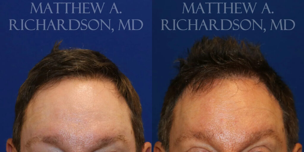 Hair Transplant Before and After photo by Texas Facial Aesthetics in Frisco, TX