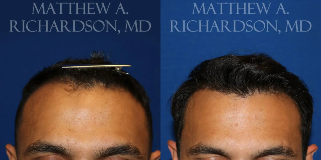 Hair Transplant Before and After photo by Texas Facial Aesthetics in Frisco, TX