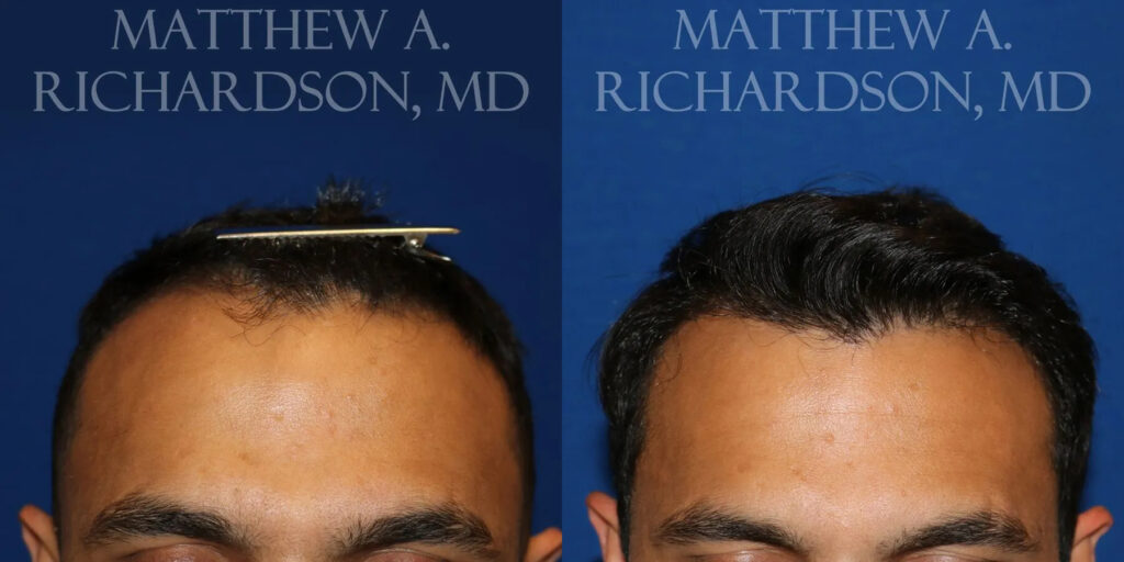 Hair Transplant Before and After photo by Texas Facial Aesthetics in Frisco, TX