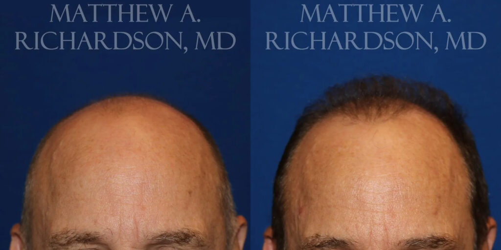 Hair Transplant Before and After photo by Texas Facial Aesthetics in Frisco, TX