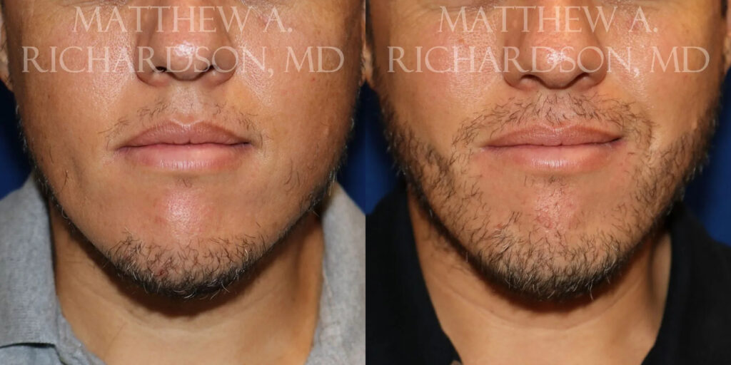 Hair Transplant Before and After photo by Texas Facial Aesthetics in Frisco, TX