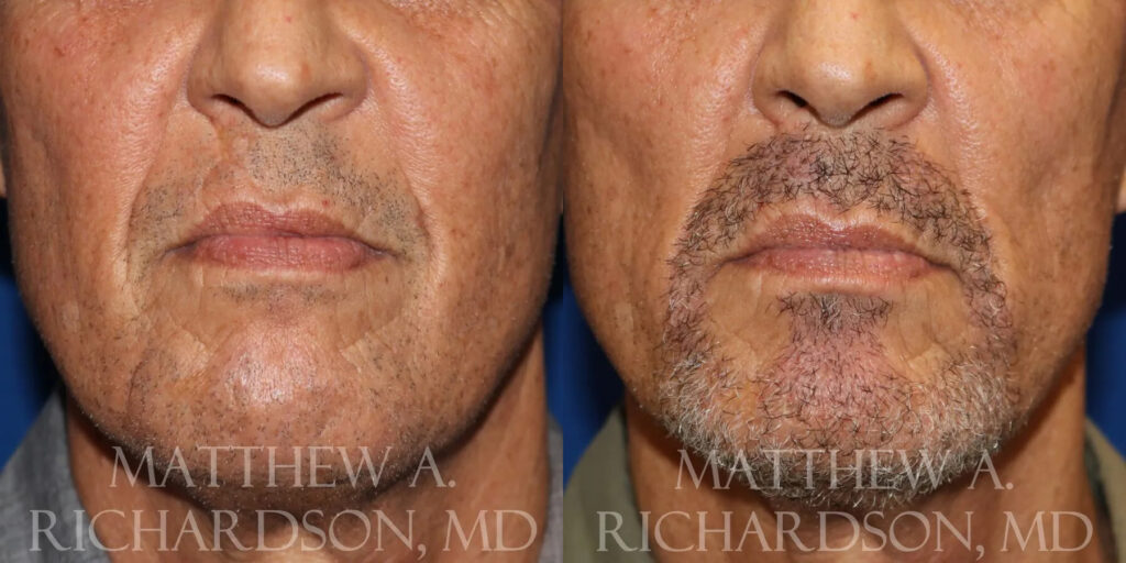 Hair Transplant Before and After photo by Texas Facial Aesthetics in Frisco, TX