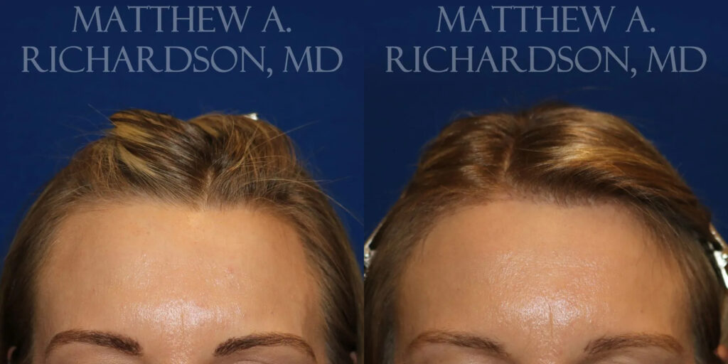 Hair Transplant Before and After photo by Texas Facial Aesthetics in Frisco, TX