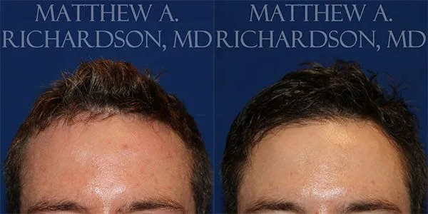 Hair Transplant Before and After photo by Texas Facial Aesthetics in Frisco, TX