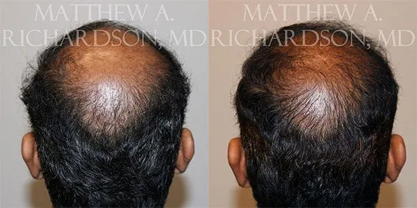 Hair Transplant Before and After photo by Texas Facial Aesthetics in Frisco, TX