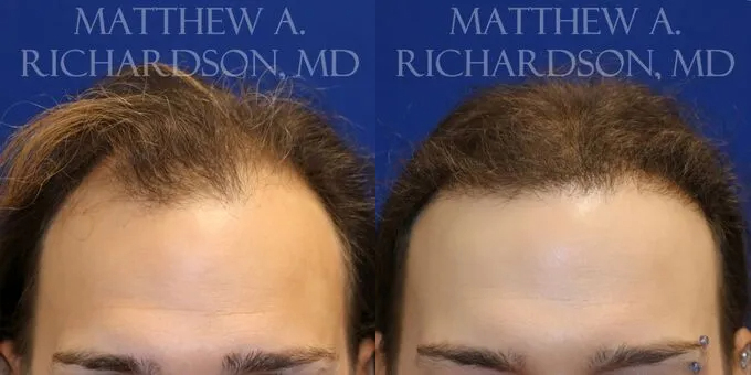 Hair Transplant Before and After photo by Texas Facial Aesthetics in Frisco, TX